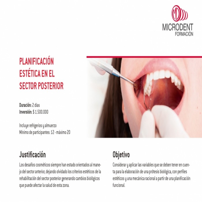 Planificación estética en el sector posterior