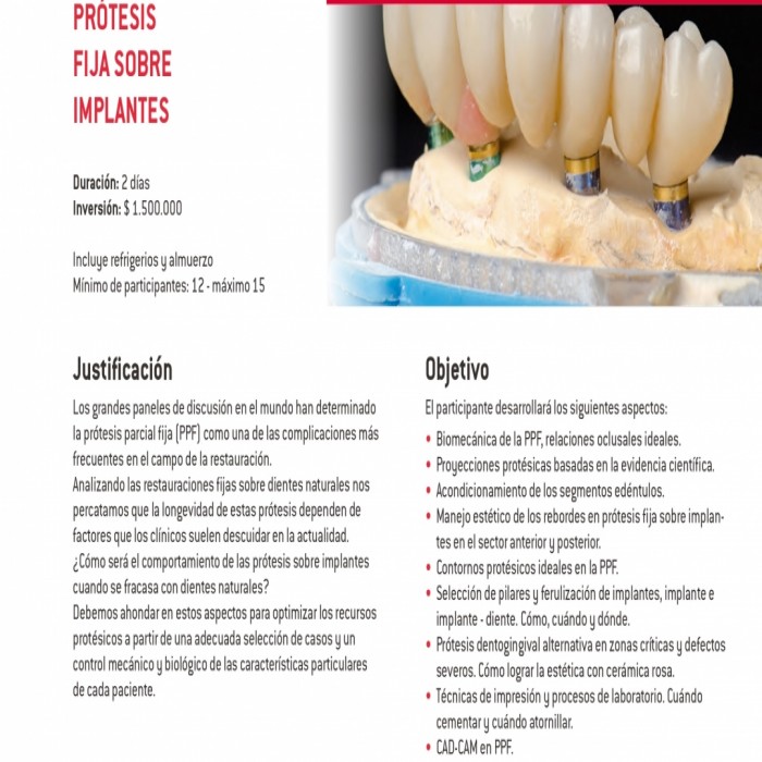 Prótesis fija sobre implates
