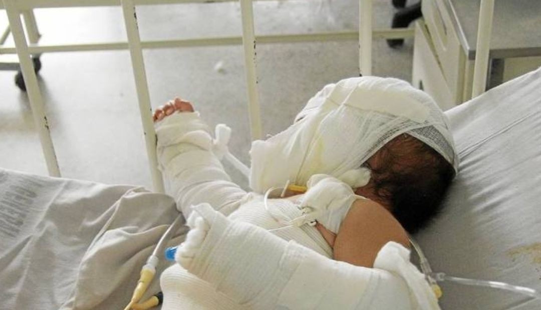 ¡Triste! Bebé de un año resulta quemada con pólvora 