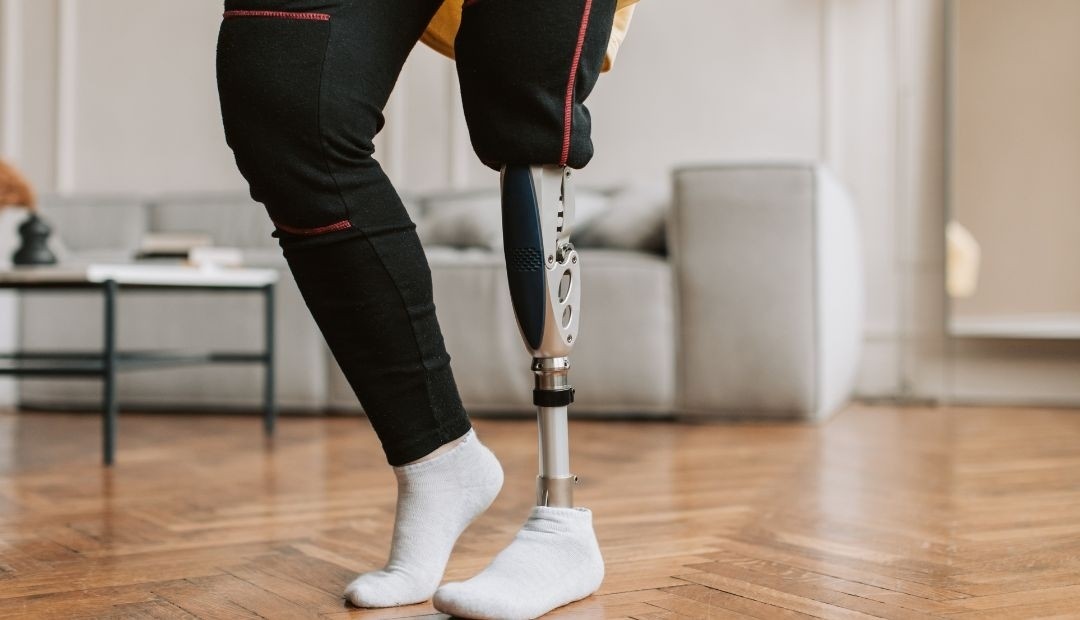 ¡Impactante! Ladrón pierde prótesis en pleno acto delictivo y es abandonado por su cómplice