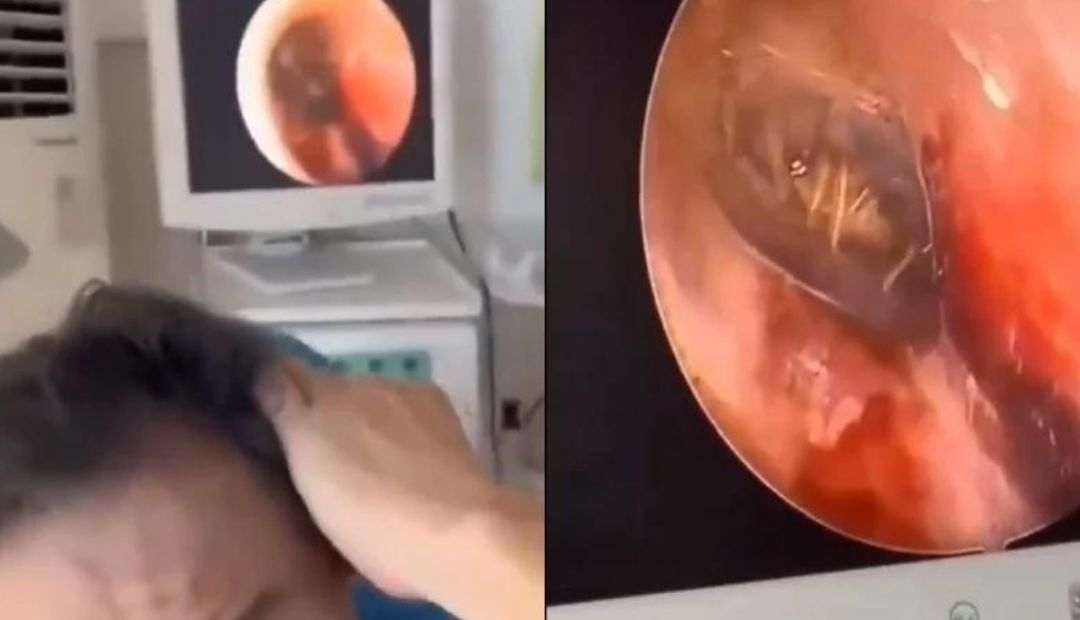 Una araña con sus huevos vivía en el oído y era la causa del dolor de cabeza de un paciente