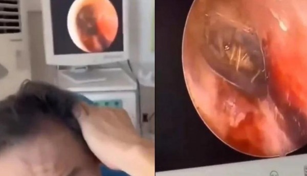 Una araña con sus huevos vivía en el oído y era la causa del dolor de cabeza de un paciente