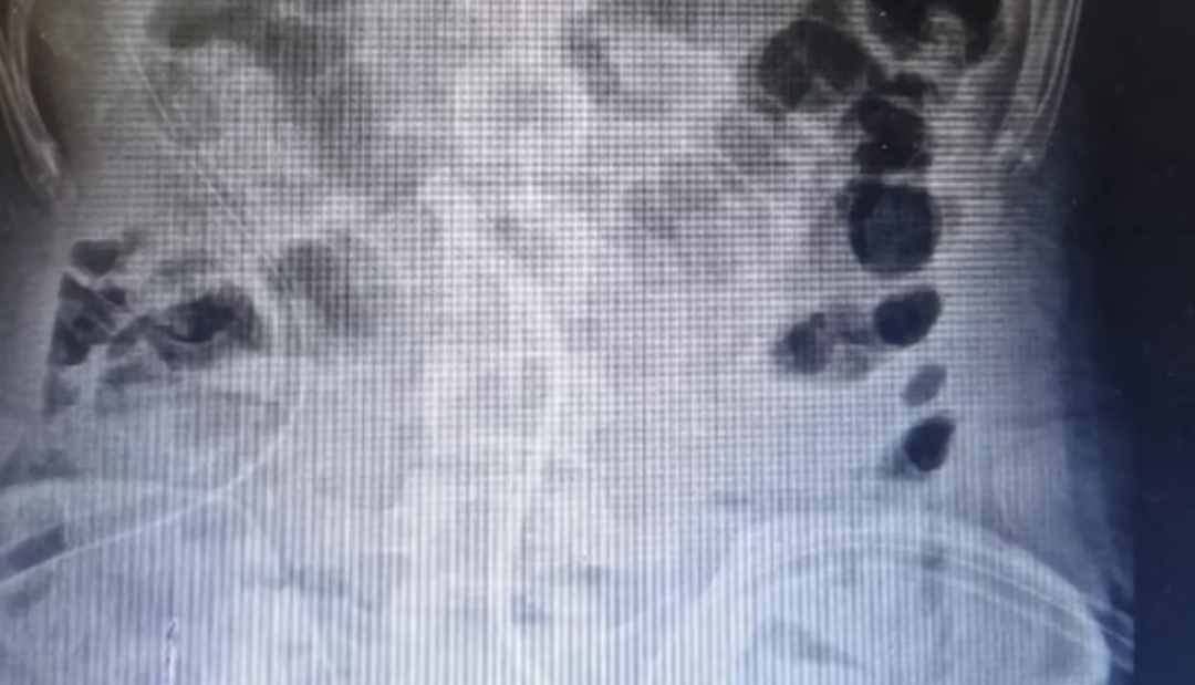 “Pensé que el zinc ayudaba en el culturismo”: hombre se tragó 39 monedas y 37 imanes