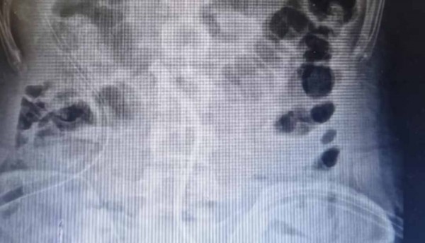 “Pensé que el zinc ayudaba en el culturismo”: hombre se tragó 39 monedas y 37 imanes