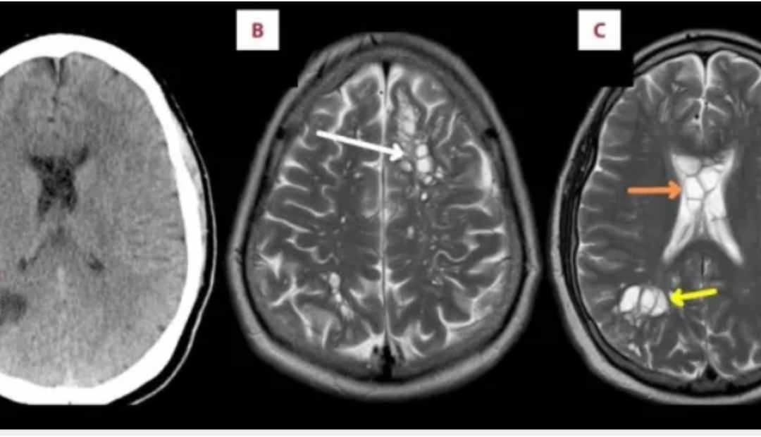 Insólito: Un hombre que se quejaba de dolores de cabeza persistentes tenía huevos de gusano viviendo en su cerebro