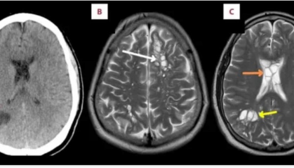 Insólito: Un hombre que se quejaba de dolores de cabeza persistentes tenía huevos de gusano viviendo en su cerebro