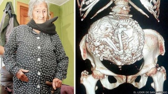 [Video] Mujer fue al médico por cálculos en la vejiga y tenía un bebé calcificado hace 30 años en el vientre