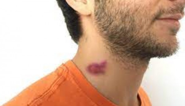 Un chupón de cuello terminó con la vida de un joven de 17 años