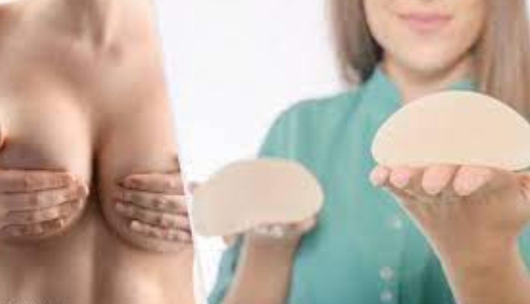 Esto es lo que debe de saber antes de realizarse una mamoplastia