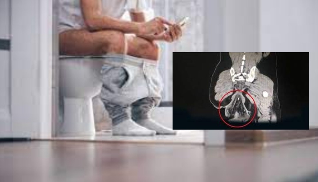 Hombre pasó mucho tiempo sentado en el inodoro y casi pierde el intestino