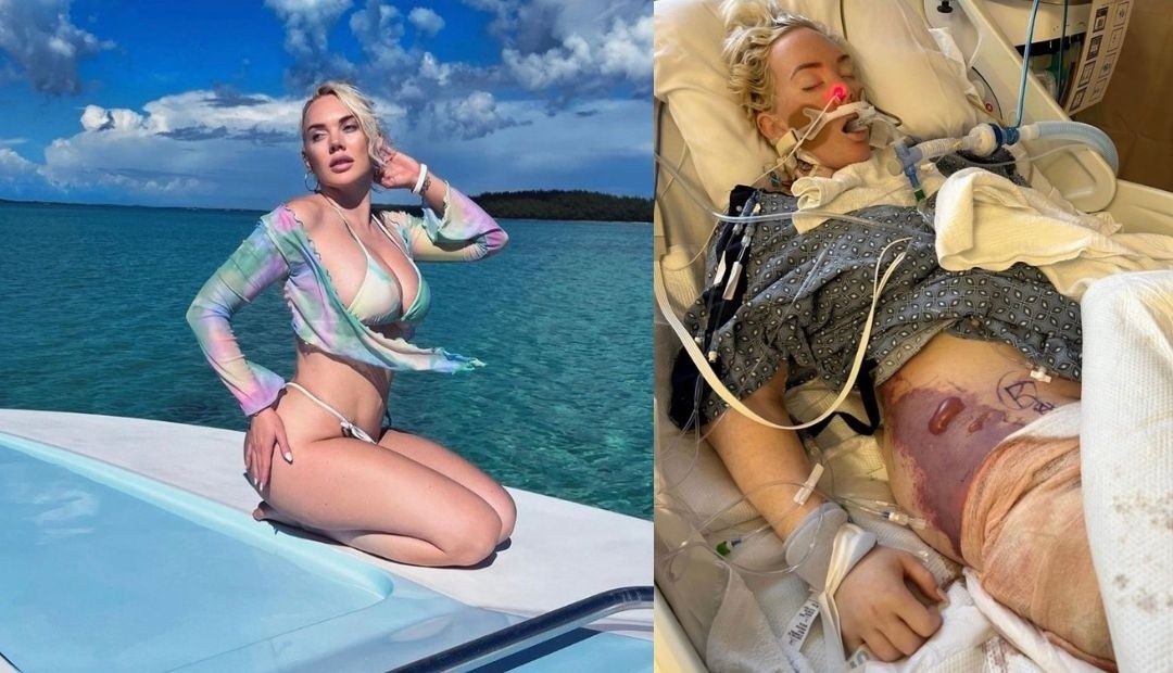 A modelo le amputaron una pierna por una bacteria carnívora